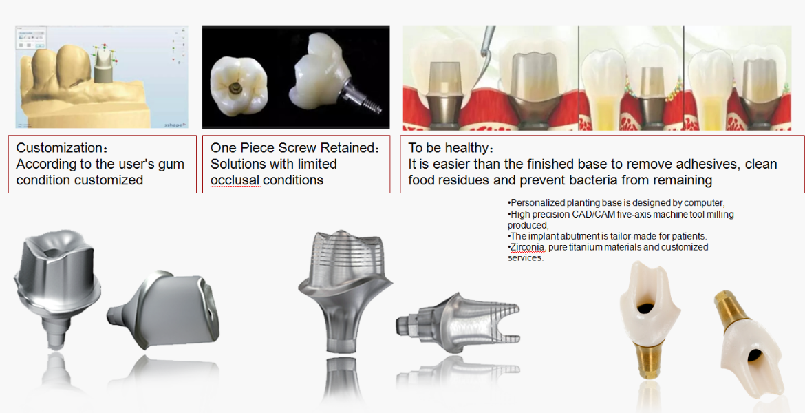 All On 4 Implant Bridge Full Mouth Solution 